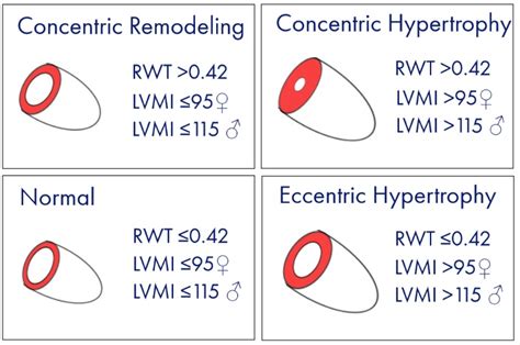 lvmi calculator